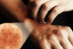 eczema atopico approf oldsite