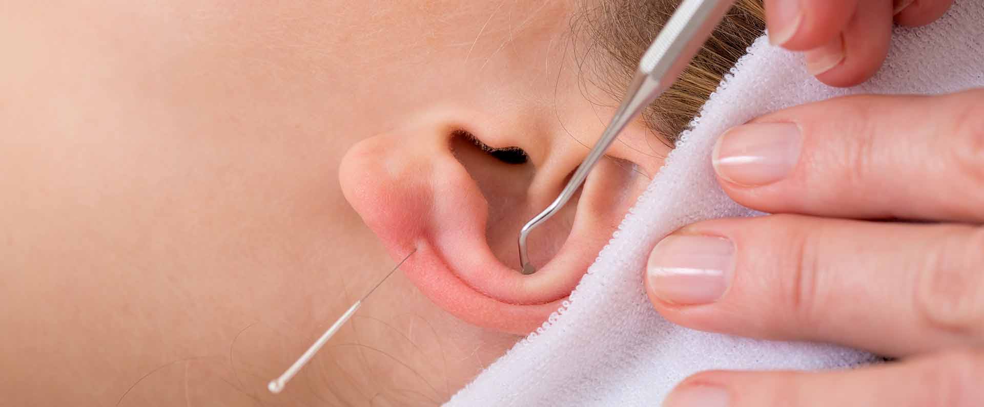 orecchio agopuntura topbig opt